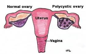 Polikistik Over Sendromu4